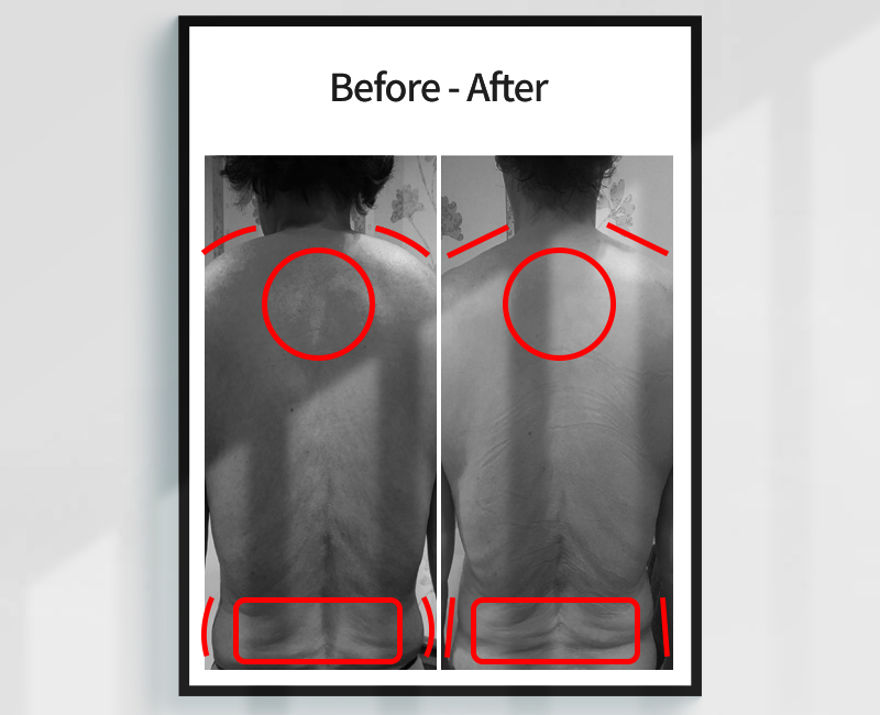 Before/After - 姿勢矯正事例